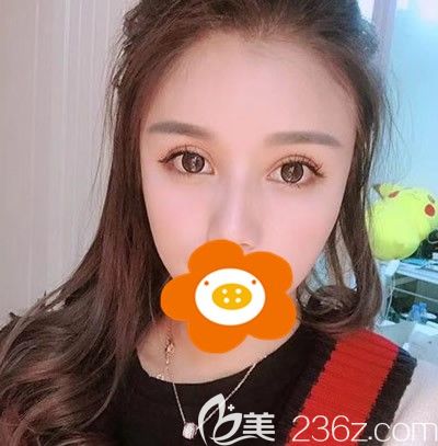 都說福州做脂肪填充好的醫(yī)生是，去美貝爾找他為我做全臉脂肪填充三個月果真如此