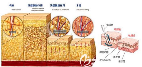 美蘭德多維立體吸脂