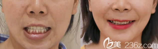 骨性凸嘴在廣州廣大做正頜手術(shù)前后照片 骨性凸嘴在廣州廣大做正頜手術(shù)前后照片