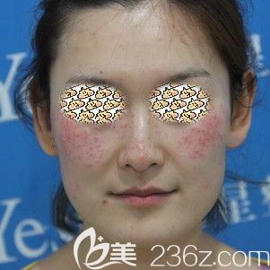 邵輝醫(yī)生幫我做皮秒激光祛斑術(shù)后即刻 邵輝醫(yī)生幫我做皮秒激光祛斑術(shù)后即刻