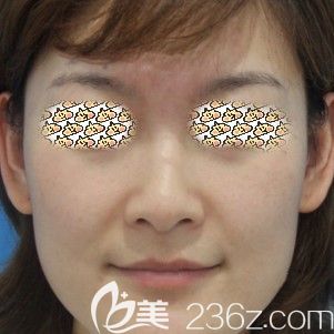 做皮秒激光術(shù)后15天紅腫消除 做皮秒激光術(shù)后15天紅腫消除