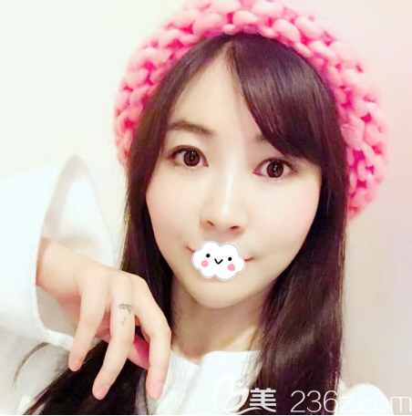 聽說廣州紫馨王永功醫(yī)生名氣很大做鼻子比較出名于是我花兩萬多元找他做了隆鼻