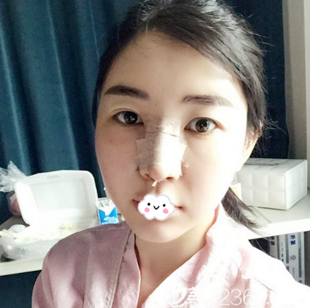 耳軟骨隆鼻術(shù)后兩天自拍 耳軟骨隆鼻術(shù)后兩天自拍