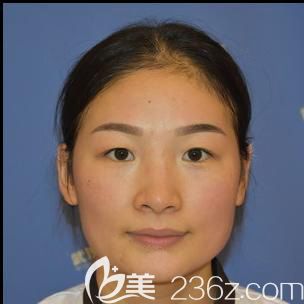 沒到寧波壹加壹做雙眼皮前 沒到寧波壹加壹做雙眼皮前