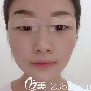 林勇完雙眼皮術(shù)后<span style= 林勇完雙眼皮術(shù)后<span style=