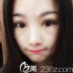 雙眼皮術(shù)后恢復(fù)十天 雙眼皮術(shù)后恢復(fù)十天