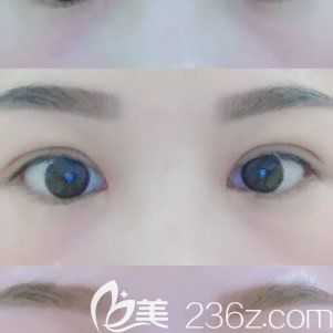 恢復(fù)二十天的雙眼皮<span style= 恢復(fù)二十天的雙眼皮<span style=