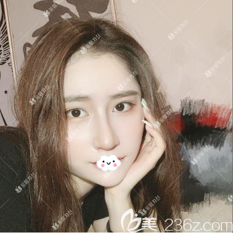 谷琪醫(yī)生做的隆鼻案例半個月自拍 谷琪醫(yī)生做的隆鼻案例半個月自拍