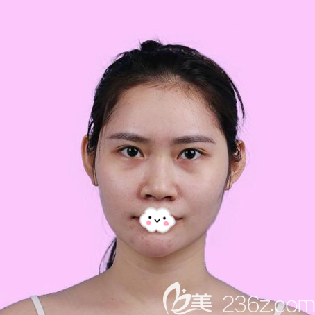 在廣州紫馨做隆鼻術(shù)前照片 在廣州紫馨做隆鼻術(shù)前照片