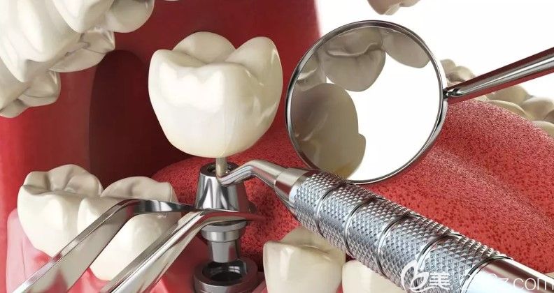 什么樣的牙齒情況適合做即刻種植