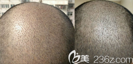 植發(fā)術(shù)后第5天和9天清洗血痂角質(zhì)對比