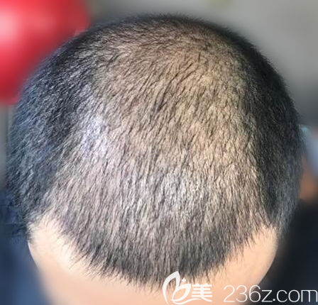 <!--<i data=20240703-sp></i>-->張橋植發(fā)案例一個月效果