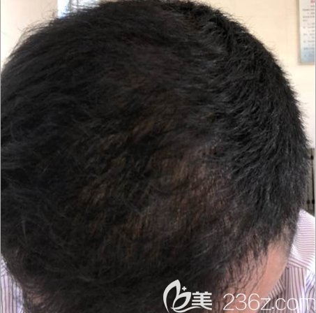 <!--<i data=20240703-sp></i>-->植發(fā)4個月照片