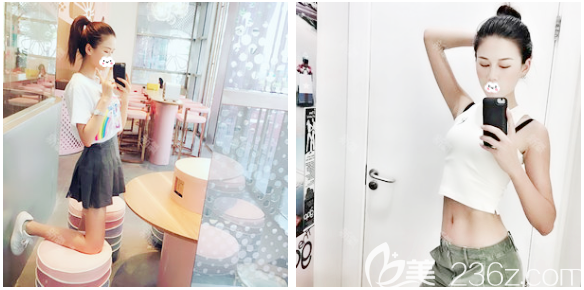 親身體驗后才知道廣州中家醫(yī)家庭醫(yī)生黃廣香不僅清奧隆胸技術(shù)好吸脂技術(shù)也很棒