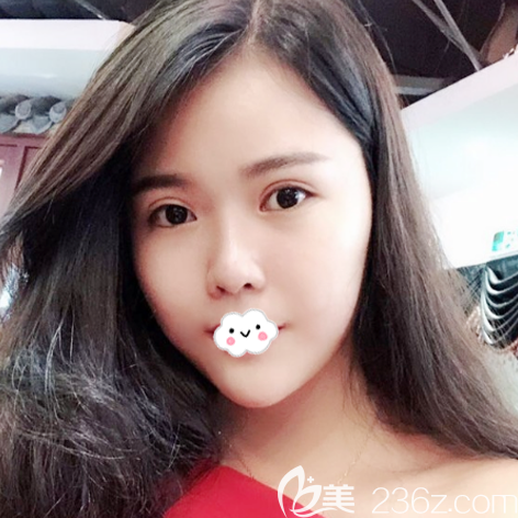 廣州紫馨整形醫(yī)院除了曹仁昌之外,谷琪醫(yī)生的雙眼皮修復案例和技術(shù)也很靠譜哦