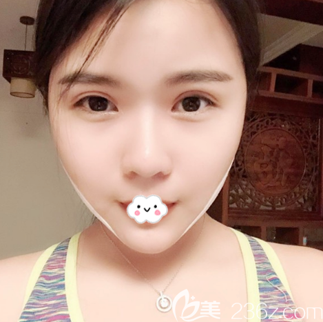 在廣州紫馨做完雙眼皮失敗修復(fù)15天自拍 在廣州紫馨做完雙眼皮失敗修復(fù)15天自拍