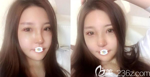 韓國原辰整形醫(yī)院輪廓術(shù)后1周恢復(fù)效果圖