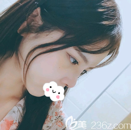 膨體隆鼻拆線后效果