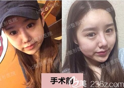 20191129_1575002732743829.jpg 術(shù)前.jpg