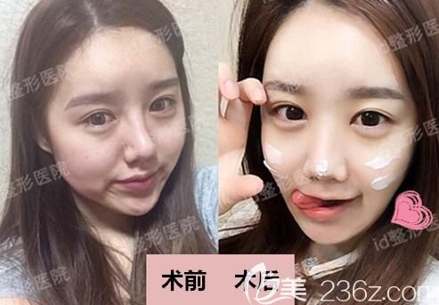 韓國id整形崔在鎬耳軟骨復合隆鼻案例 韓國id整形崔在鎬耳軟骨復合隆鼻案例