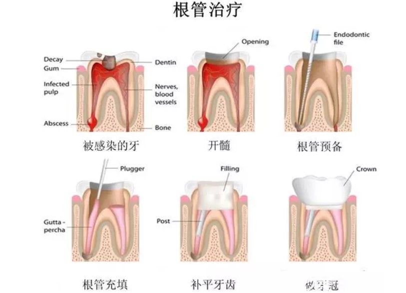 根管治療的步驟圖解 根管治療的步驟圖解