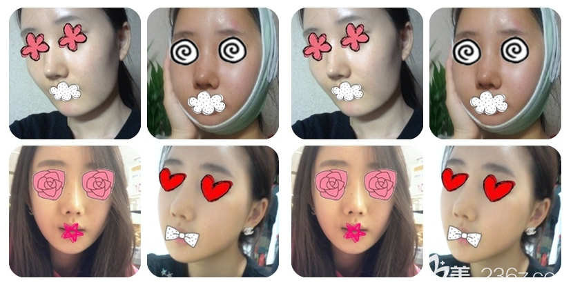 韓國(guó)博朗溫接受人字截骨和3D顴骨術(shù)案例圖