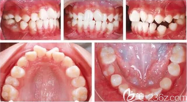 惠州致美口腔牙列擁擠+埋伏阻生矯正實例