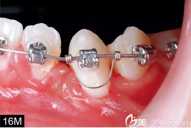 惠州致美口腔兒童矯正案例