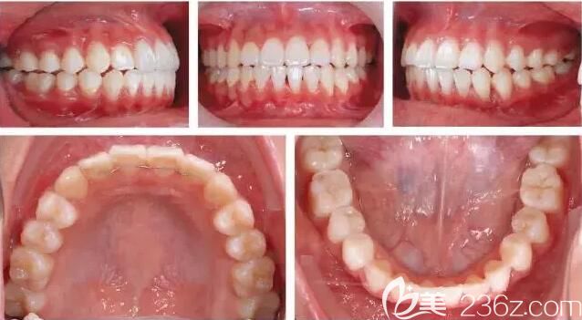 惠州致美齒科牙齒矯正真人案例