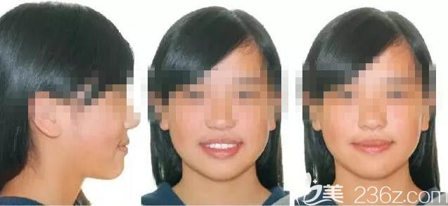 惠州致美口腔正畸案例分享:牙列擁擠+埋伏阻生牙Damon自鎖托槽矯正實(shí)例