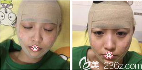 手術(shù)當(dāng)天