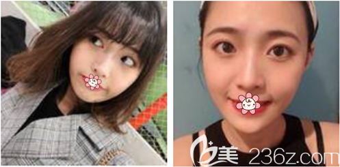 貴陽美萊做自體脂肪面部填充效果好不好