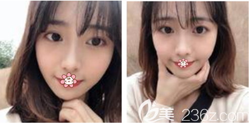 <!--<i data=20240703-sp></i>-->自體脂肪全臉填充術(shù)后2個(gè)月