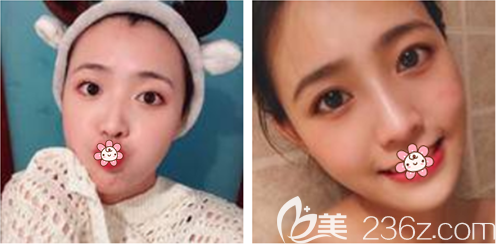 我在貴陽美萊整形美容醫(yī)院做的自體脂肪全臉填充恢復(fù)3個(gè)月效果就顯現(xiàn)了！