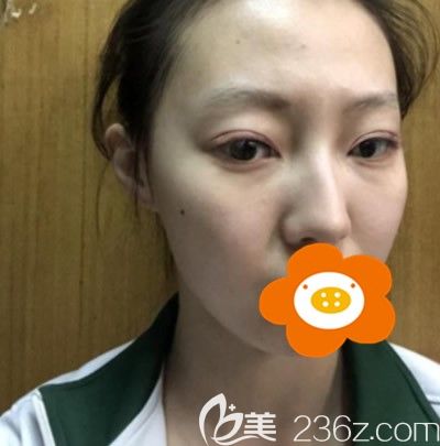 做完雙眼皮術(shù)后7天眼睛還有點腫