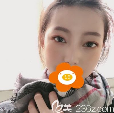 在福州美貝爾做切開雙眼皮+開內(nèi)眼角三個月沒有出現(xiàn)疤痕增生，今天把恢復效果圖分享一下