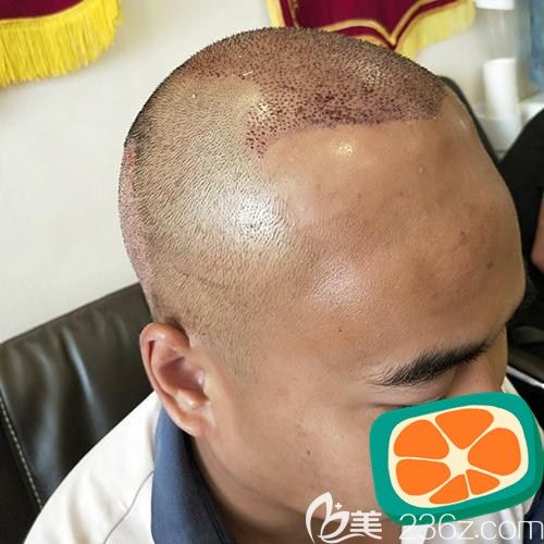 成都碧蓮盛植發(fā)術(shù)后即刻效果圖