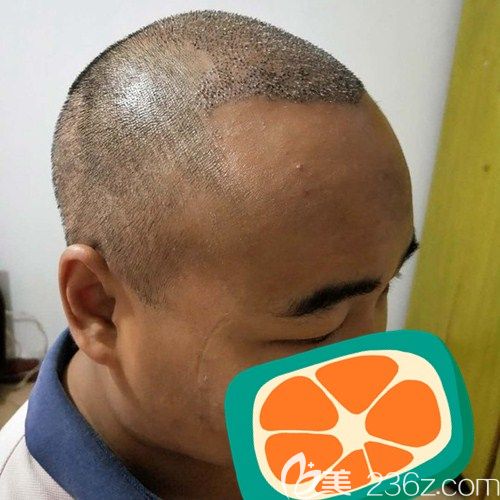 成都碧蓮盛頭頂加密種植術(shù)后5天