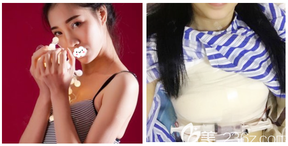 在廣州藝美整形做復(fù)合隆胸術(shù)前照片 在廣州藝美整形做復(fù)合隆胸術(shù)前照片