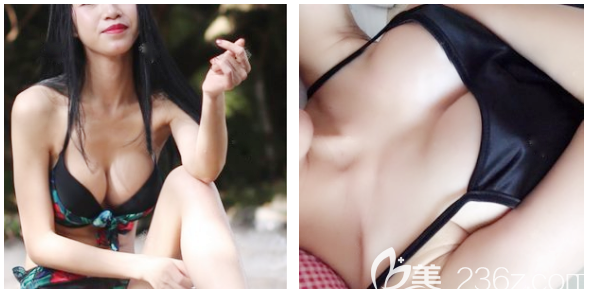 廣州藝美李闖復(fù)合隆胸躺下后的自然真實效果圖 廣州藝美李闖復(fù)合隆胸躺下后的自然真實效果圖