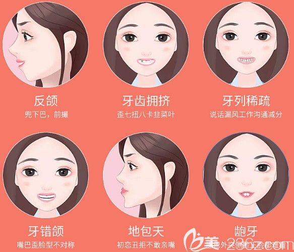 哪些牙齒情況可以戴隱適美牙套 哪些牙齒情況可以戴隱適美牙套