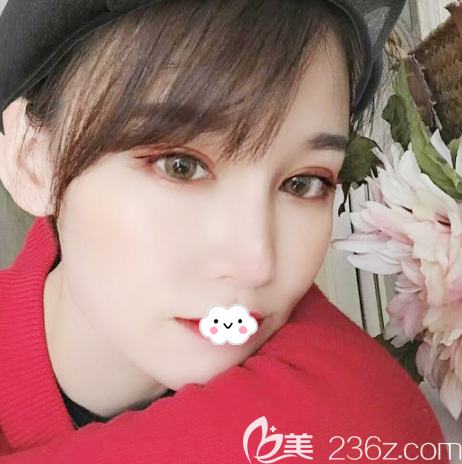 廣州藝美整形眼鼻脂肪填充一個月案例效果圖 廣州藝美整形眼鼻脂肪填充一個月案例效果圖