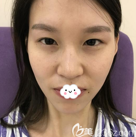 在廣州藝美做脂肪填充和雙眼皮隆鼻術前照片 在廣州藝美做脂肪填充和雙眼皮隆鼻術前照片