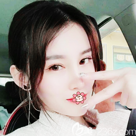 廣州藝美整形張濤雙眼皮隆鼻脂肪填充案例效果圖 廣州藝美整形張濤雙眼皮隆鼻脂肪填充案例效果圖