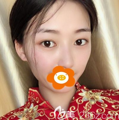 術(shù)后半個(gè)月鼻子還有點(diǎn)腫 術(shù)后半個(gè)月鼻子還有點(diǎn)腫