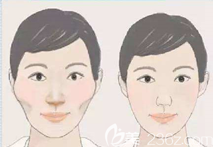 顴骨顴弓手術(shù)前后