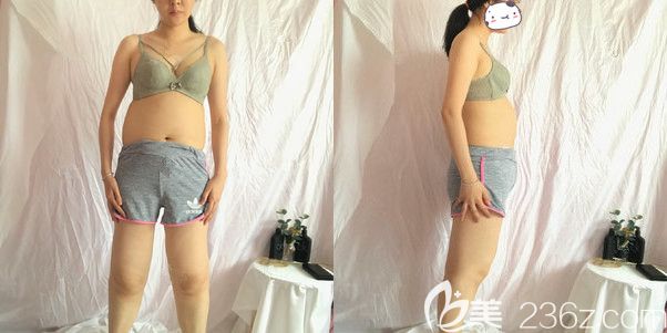 面診南京華美術(shù)前腰腹部贅肉和腿粗 面診南京華美術(shù)前腰腹部贅肉和腿粗