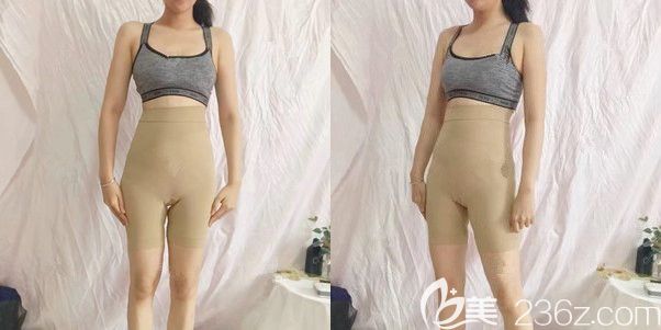 做完大腿吸脂術(shù)后穿著塑身衣 做完大腿吸脂術(shù)后穿著塑身衣