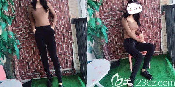 術(shù)后半個月腰腹部及大腿恢復(fù)情況 術(shù)后半個月腰腹部及大腿恢復(fù)情況