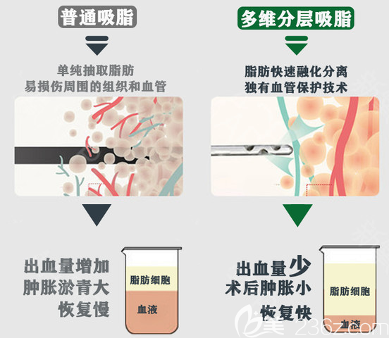 廣州藝美整形李向陽(yáng)醫(yī)生吸脂優(yōu)勢(shì) 廣州藝美整形李向陽(yáng)醫(yī)生吸脂優(yōu)勢(shì)